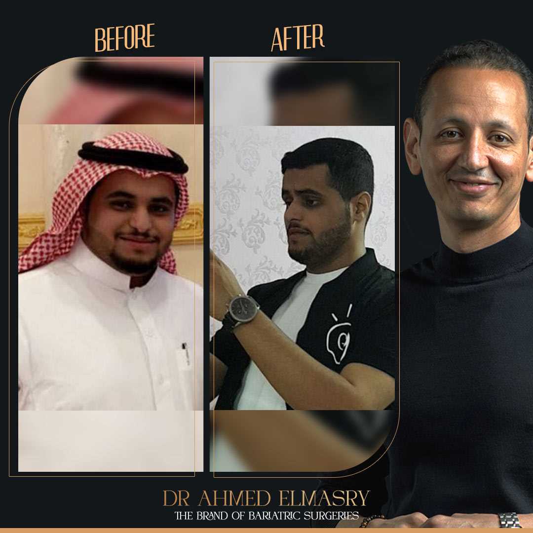 40 Kilos weight loss in only 4 months..after Gastric Sleeves!